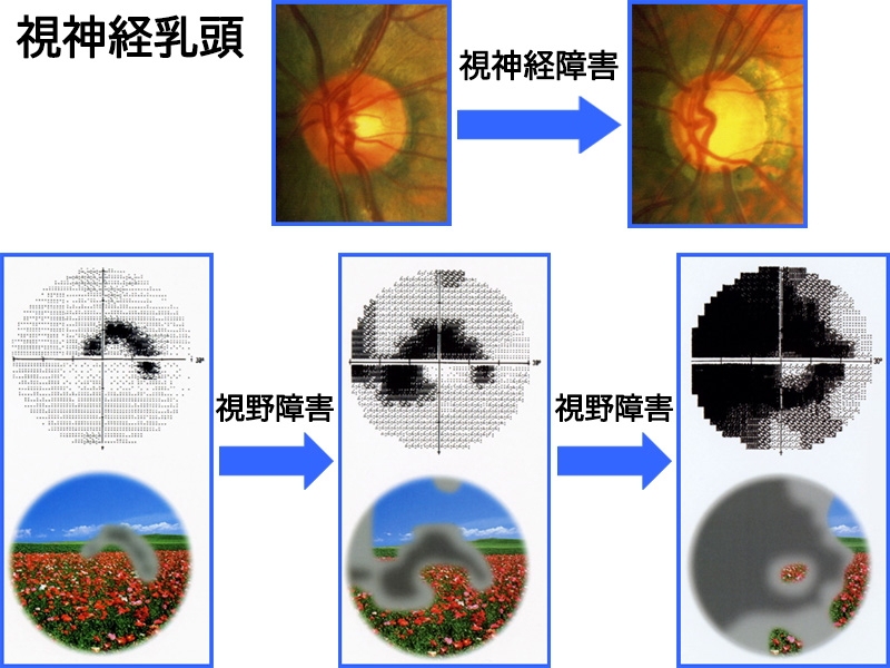 圧 方法 下げる 眼 を